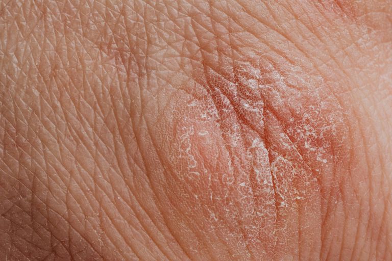 La thérapie de l'ozone pour les maladies de la peau : mécanismes cellulaires et moléculaires